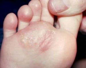 قارچ پوستی-عفونت های قارچی پا Skin fungus – Athletes Foot